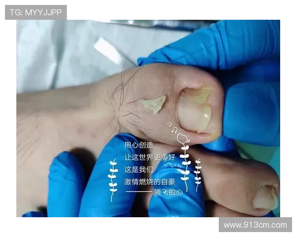 足球明星因甲沟炎困扰赛季表现专家解析病因与康复之道